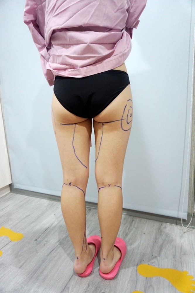大小腿抽脂,大腿抽脂,小腿抽脂,馬鞍肉抽脂,抽脂手術,李岳樺醫師,博恩妍